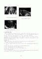 자궁근종 (Uterus myoma) 3페이지