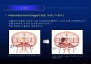 뇌졸중에 대한 발표자료 9페이지