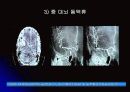 뇌 동  맥 류(Cerebral Aneurysm) 25페이지