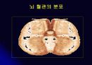 뇌 동  맥 류(Cerebral Aneurysm) 32페이지
