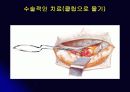 뇌 동  맥 류(Cerebral Aneurysm) 35페이지