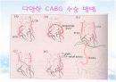  Angina pectoris 환자의 CABG(협심증) 15페이지