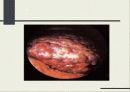 간경화증 [liver cirrhosis] -치료 식이의 지침- 4페이지