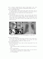 폐렴환자 사례연구 6페이지