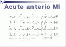 심근경색 15페이지