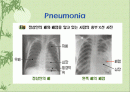 pneumonia환자간호 ppt. 2페이지