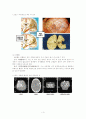 [뇌졸중] 의료사회복지론 - 뇌졸중 3페이지