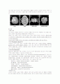 뇌경색 간호과정 사례 보고서 2페이지