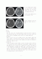 뇌내출혈 간호사례 연구 (ICH) 11페이지