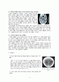 뇌내 출혈(Intracerebral Hemorrhage, ICH) 4페이지