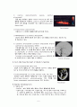 뇌내 출혈(Intracerebral Hemorrhage, ICH) 5페이지