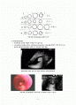 자궁내막폴립 (Endometrial polyp)  2페이지