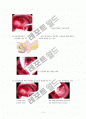 자궁내막폴립 (Endometrial polyp)  3페이지