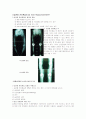 골관절염(osteoarthritis) OA 케이스 2페이지