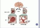 뇌내출혈 ICH 5페이지