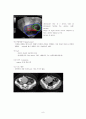 모성간호학-실습 케이스 자궁근종(Uterine myoma) 8페이지