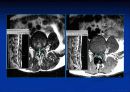 척추질환에 따른 영상의학 영상 15페이지