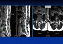 척추질환에 따른 영상의학 영상 20페이지