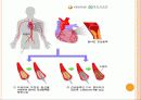 심근경색( Myocardial Infarction. MI ) CASE 22페이지