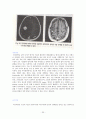 뇌종양 환자의 간호 25페이지