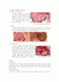 TONGUE CANCER(구강암)설암 csae study 6페이지