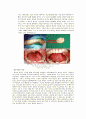 TONGUE CANCER(구강암)설암 csae study 10페이지