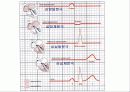 심전도[Electrocardiogram , ECG, 心電圖, EKG]  12페이지