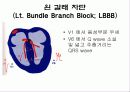 심전도[Electrocardiogram , ECG, 心電圖, EKG]  25페이지