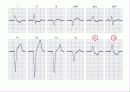 심전도[Electrocardiogram , ECG, 心電圖, EKG]  26페이지