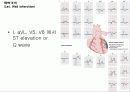 심전도[Electrocardiogram , ECG, 心電圖, EKG]  34페이지