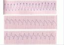 심전도[Electrocardiogram , ECG, 心電圖, EKG]  45페이지