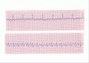 심전도[Electrocardiogram , ECG, 心電圖, EKG]  47페이지