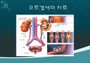 요로결석의 원인과 증상 및 진단과 치료 식이요법 18페이지
