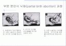 낙태 (落胎, abortion) 7페이지