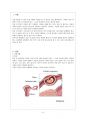 [모성간호학] 자궁외임신(ectopic pregnancy) 2페이지