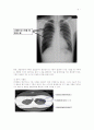 기흉환자의 흉강경을 이용한 폐기포절제술 6페이지