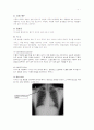 기흉환자의 흉강경을 이용한 폐기포절제술 7페이지