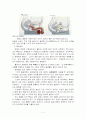 [케이스스터디][비뇨기계] 혈뇨(hematuria)  3페이지