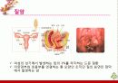 부인암 - 자궁경부암, 자궁내막암, 난소암, 질암 31페이지