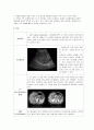 간세포암 (Hepatocellular Carcinoma) 케이스 스터디 4페이지