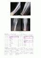 Lt. distal tibia & fibular Fx 13페이지