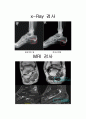 스포츠 선수의 Plantar fasciitis 손상및 치료,재활과정 3페이지