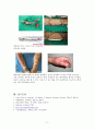 동정맥루(AVF : Arteriovenous fistula) 수술과 간호 17페이지