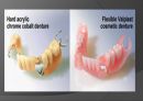 탄성국소의치(Flexible partial denture).ppt 21페이지