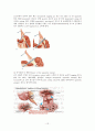 충수절제술(appendectomy)과 수술간호 12페이지