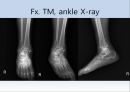 Fx. TM,Ankle(삼과골절).ppt 15페이지