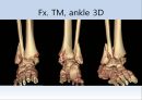 Fx. TM,Ankle(삼과골절).ppt 16페이지