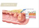 대장암, 대장내시경, 대장암치료20130524 5페이지