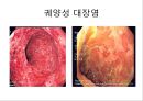 대장암, 대장내시경, 대장암치료20130524 42페이지