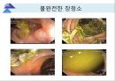 대장내시경에서 발견되는 소견 (대장 용종 및 대장암, 기타 소견).ppt 14페이지